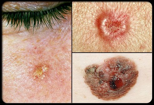 http://images.medicinenet.com/images/slideshow/summerskin_rm_collage_of_precancerous_skin_growths_s17.jpg