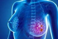 Iodine for Breast Cancer Treatment
