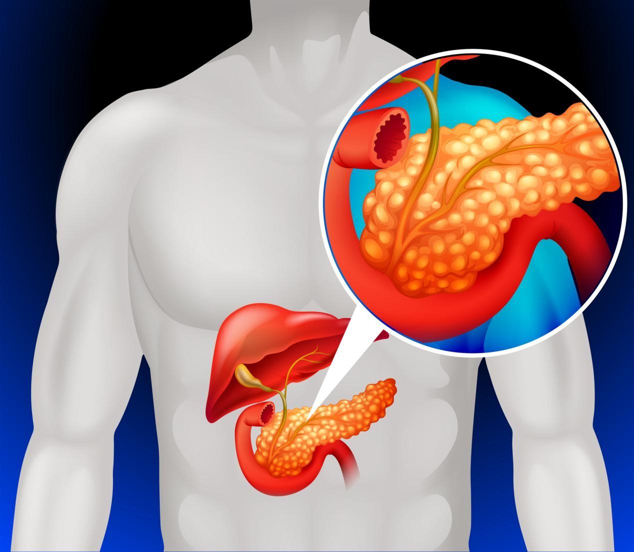 understanding-pancreatic-cancer-causes-and-treatments