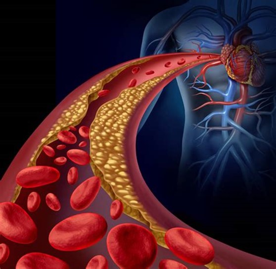 Atherosclerotic Cardiovascular and Cerebrovascular Disease Treatments