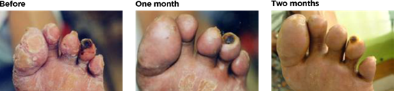 Three close-up images showing feet with severe tissue damage and gangrene affecting multiple toes.