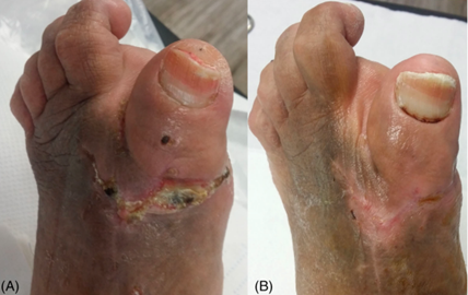 Two medical images of a foot showing healing after surgery or infection, with visible scarring and reduced inflammation.