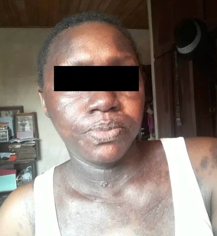 Portrait of the same woman at a later time, with improved skin appearance and a black bar covering her eyes.