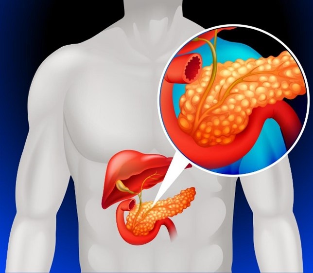 Medical illustration highlighting the pancreas and a pancreatic tumor inside the body.